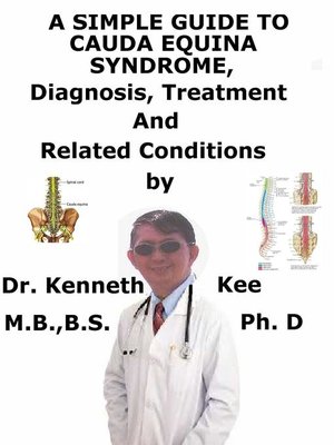 cover image of A Simple Guide to Cauda Equina Syndrome, Diagnosis, Treatment and Related Conditions